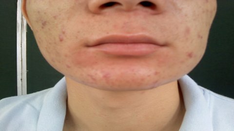 Mặt[-]bệnh[-]nhân[-]bị[-]bạnh[-]ra[-]vì[-]giun[-]gây[-]áp[-]xe.